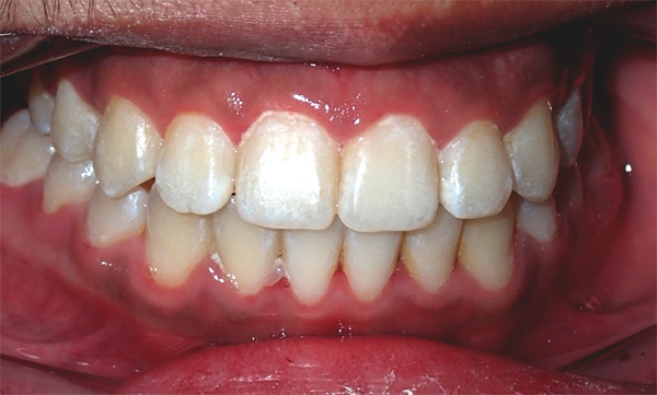 Braces - Before and After Images - After
