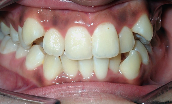 Braces - Before and After Images - Before