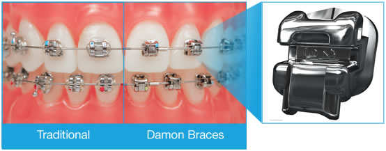 Damon Self-Ligating Aligners